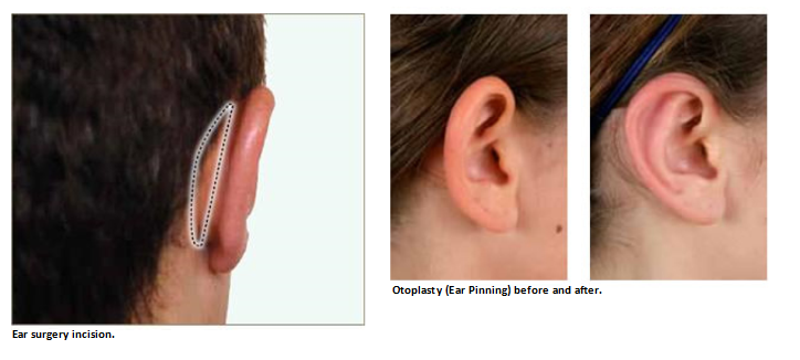 Ear cosmetic deals